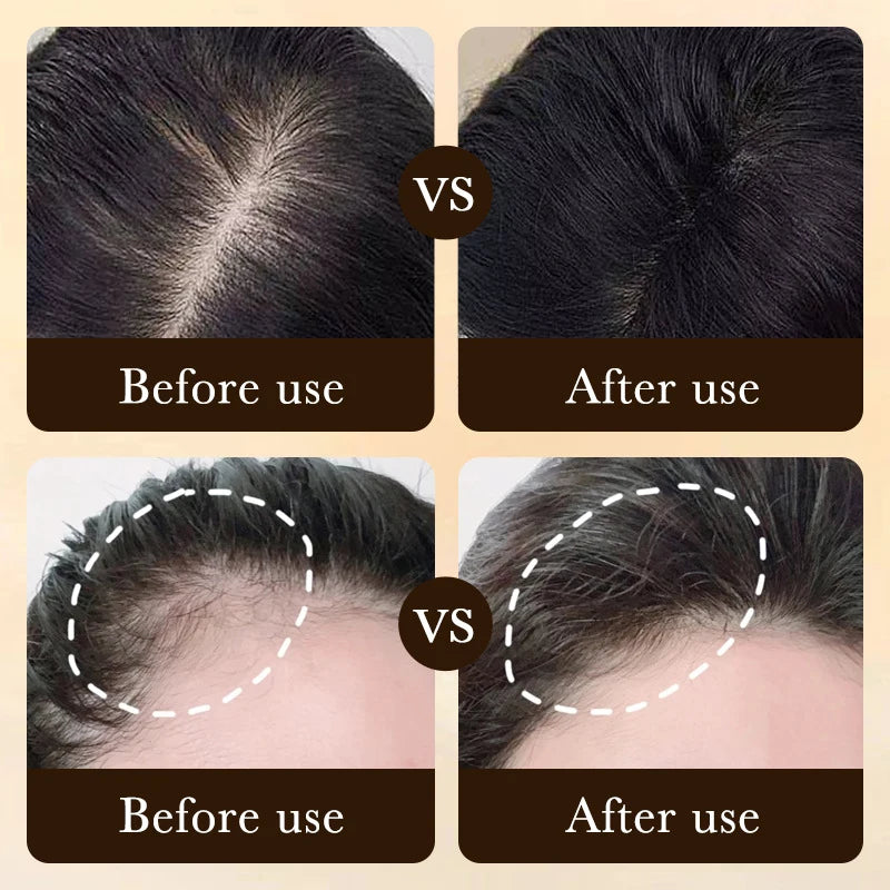 Anti Hair Loss Fast Hair Growth Essence Effective Serum Baldness Repair Hereditary Postpartum Seborrheic Hair Loss Hair Care