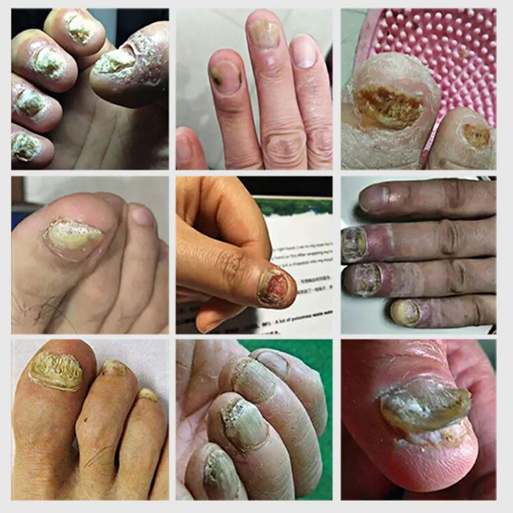 Nail Fungal Treatment Essential Oil Foot Toe Nail Fungus Removal Serum 7 Days Repair Onychomycosi Anti Infection Care Products