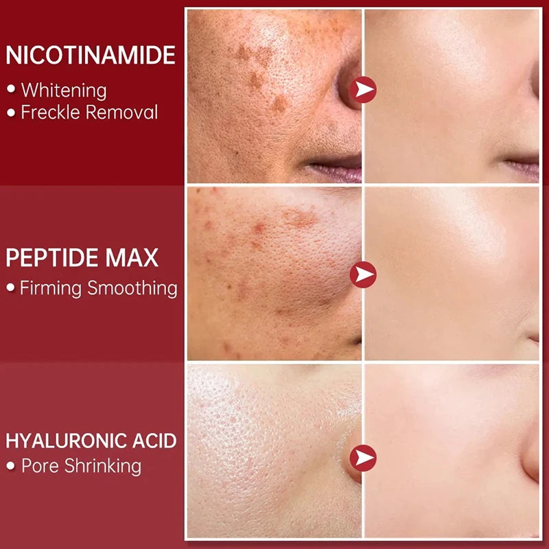 Niacinamide Facial Whitening Serum Moisturising Hyaluronic Acid Remove Dark Spots Acne Pockmarks Acne Pits Skin Care